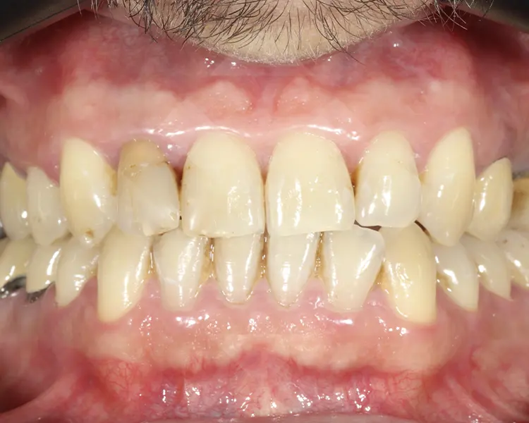 Caso implantes dentales antes
