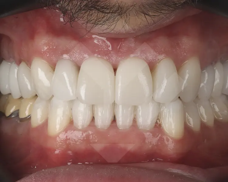 Caso implantes dentales antes