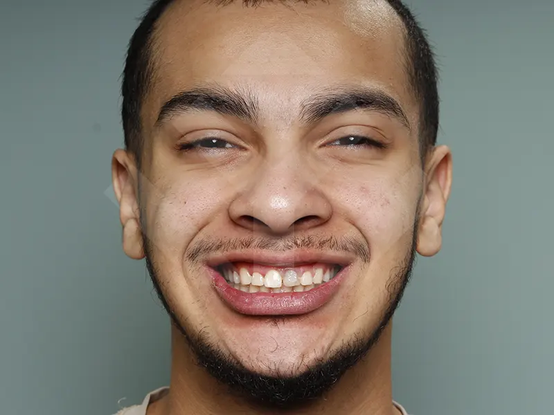 caso periodoncia antes