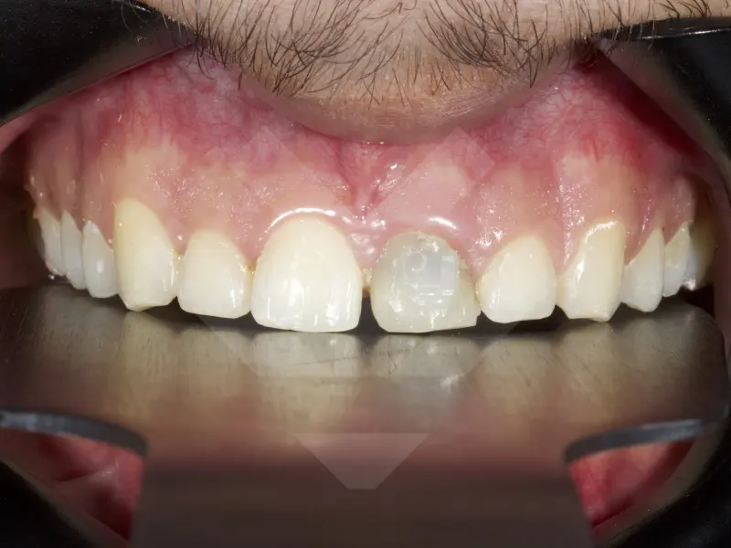 caso periodoncia antes