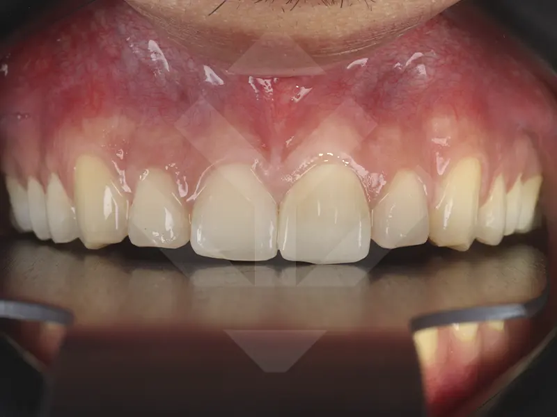 caso periodoncia después