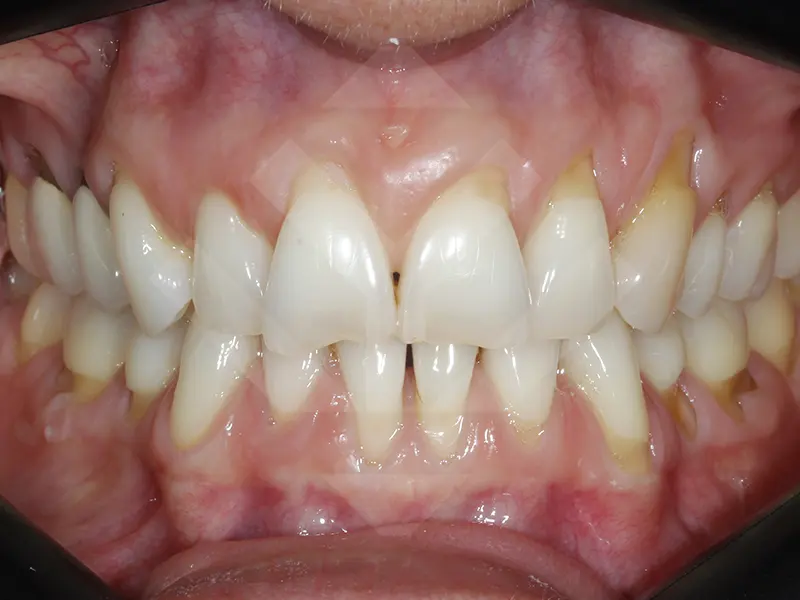 caso periodoncia antes