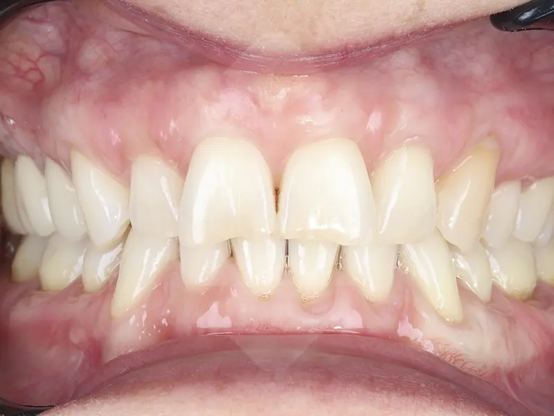 caso periodoncia después