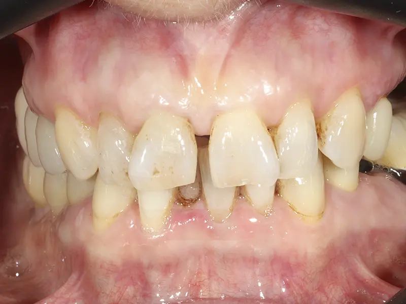 ORTHODONTIE INVISIBLE ANTES