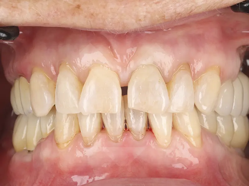 ORTHODONTIE INVISIBLE DESPUES